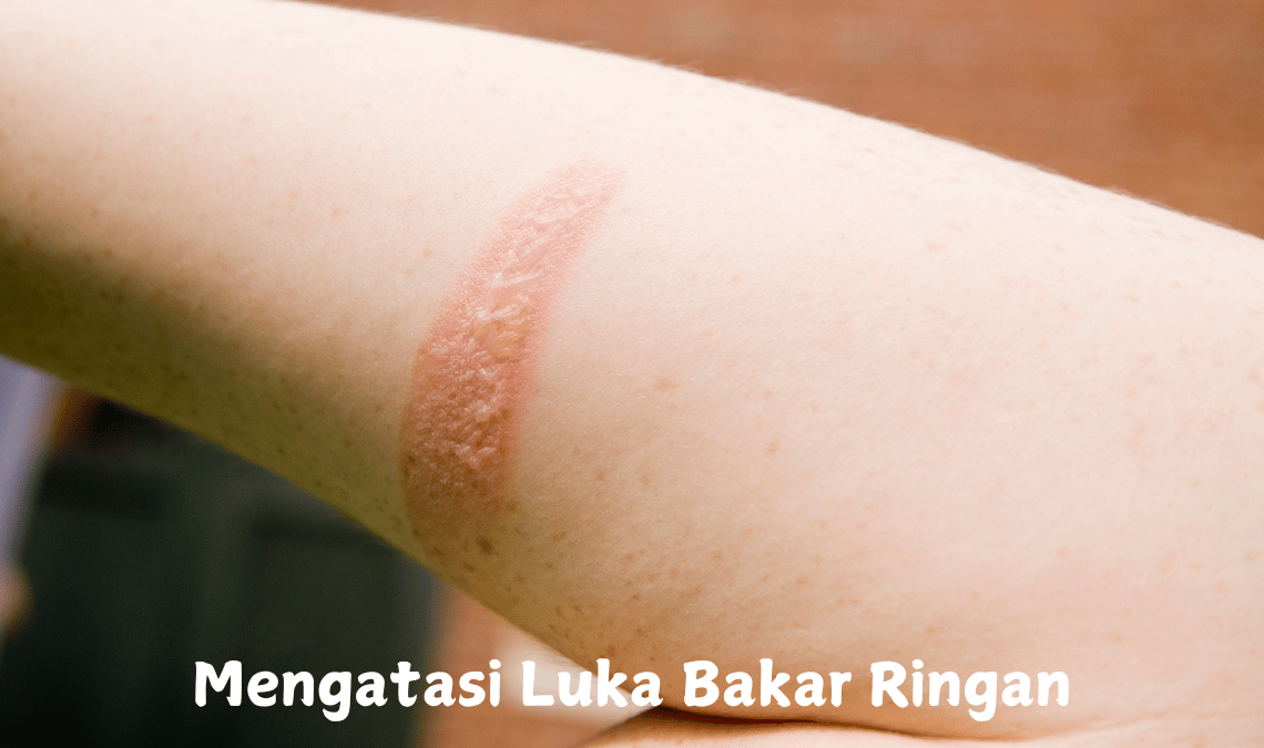 Mengatasi Luka Bakar Ringan